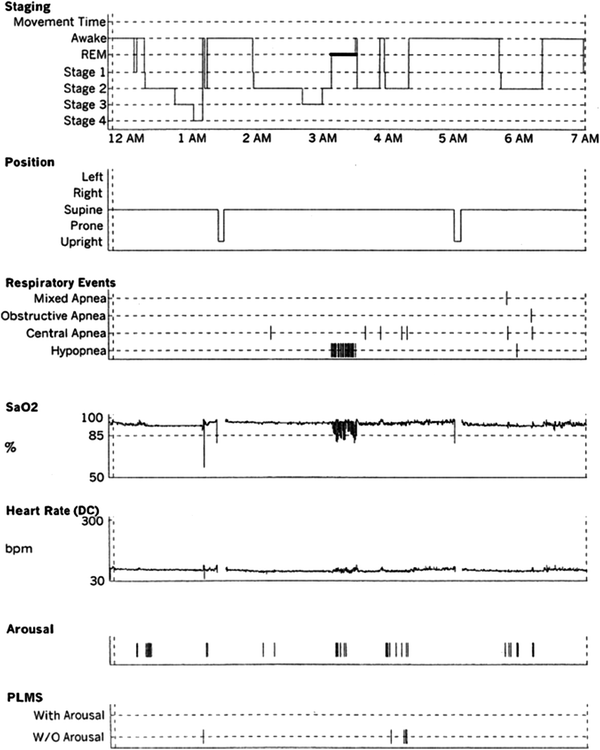 Sleep Breathing And Neurologic Disorders Springerlink