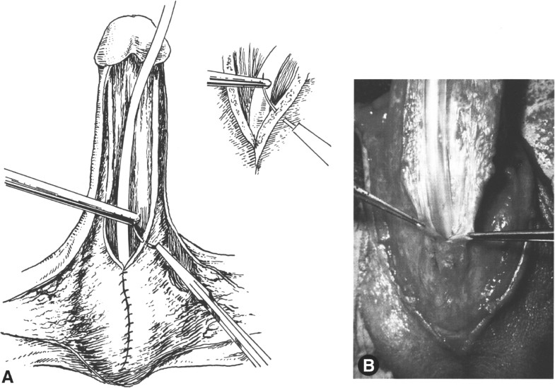 Staged Urethroplasty SpringerLink