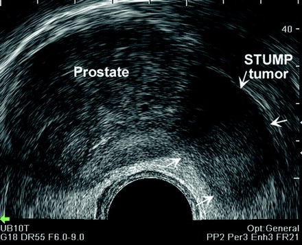 Transrectal Ultrasound Of The Prostate Springerlink