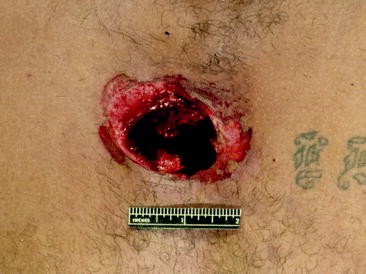 Gunshot Wound Deaths Springerlink Gunshot Wound Deaths Springerlink