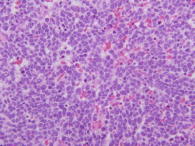 Retinoblastoma Clinical And Molecular Perspectives Springerlink