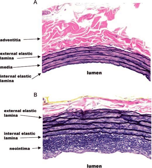 Rat Carotid Artery Balloon Injury Model | SpringerLink