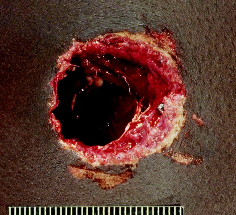 Get Bullet Graze Wound Foot Pics