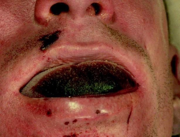 Petechiae on face due to strangulation