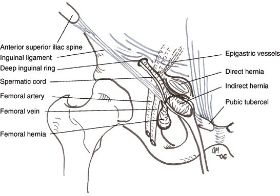 Inguinal Hernia | SpringerLink Inguinal Hernia | SpringerLink