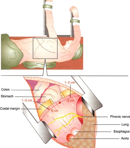 Transthoracic Esophagectomy Springerlink