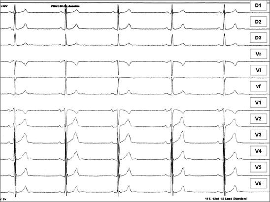 Paroxysmal Atrial Fibrillation In A Professional Cyclist Springerlink