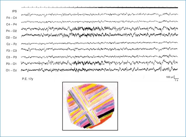 Idiopathic Photosensitive Occipital Lobe Epilepsy | SpringerLink