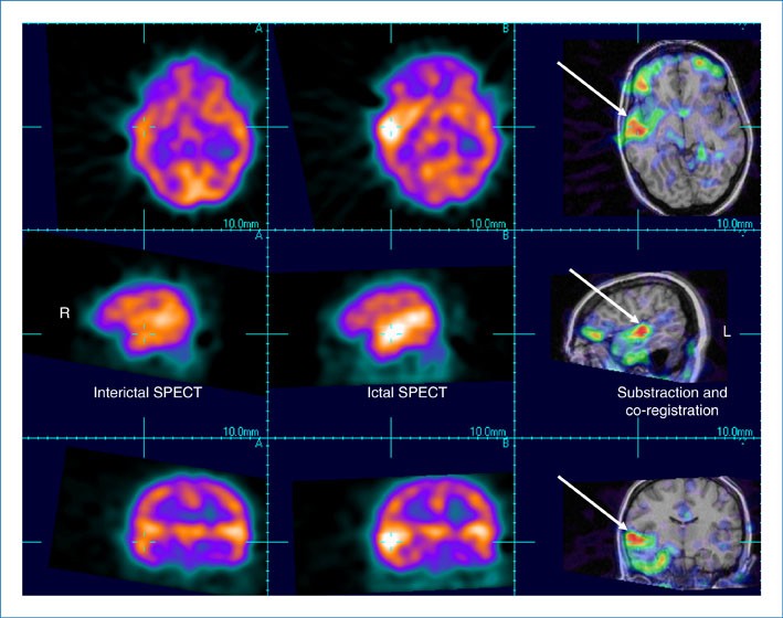 Focal Seizures with Auditory Hallucinations | SpringerLink
