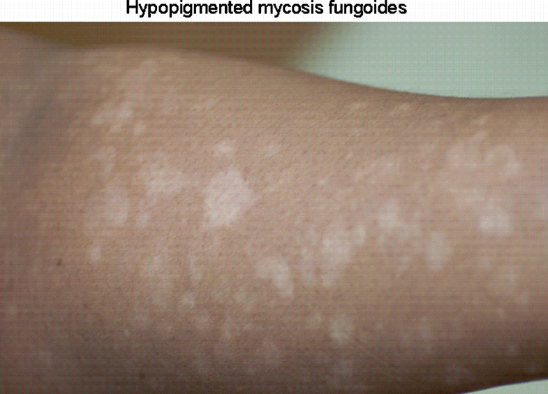 Light Therapies for Cutaneous TCell Lymphoma SpringerLink