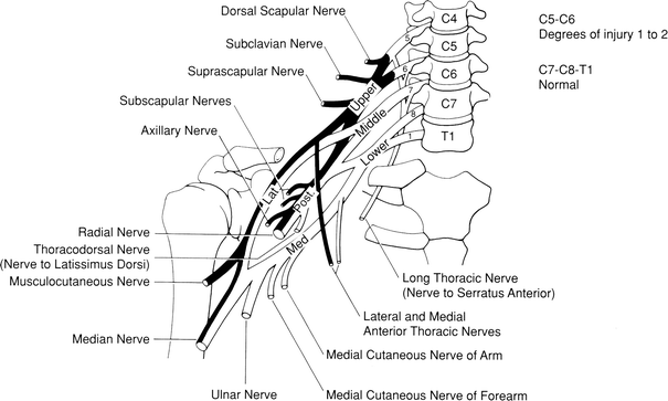 Brachial Plexus Injuries Chart