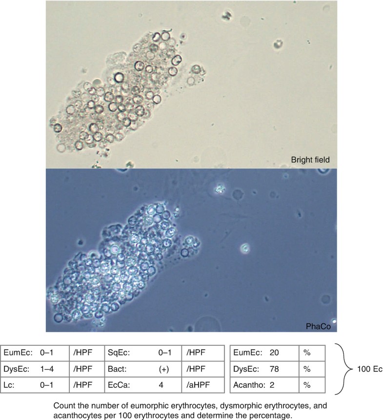 Microscopic Urine Sediment Analysis And Findings Springerlink