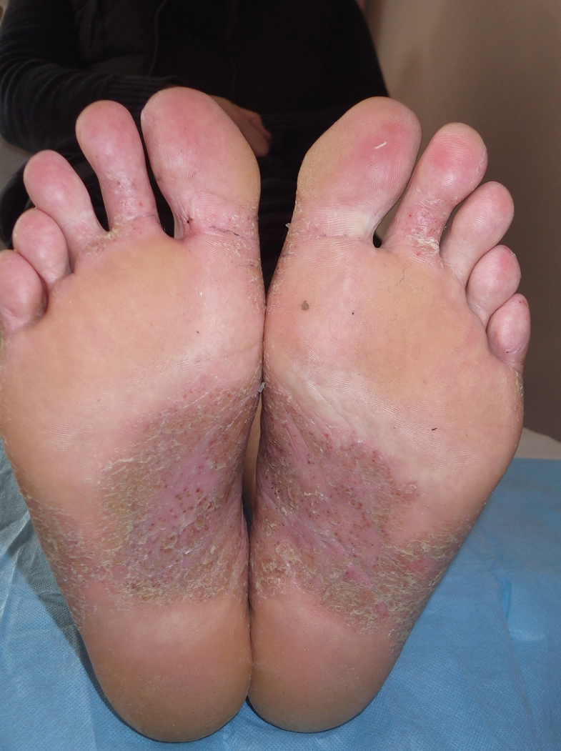 Management Of Psoriasis In Primary Care Springerlink
