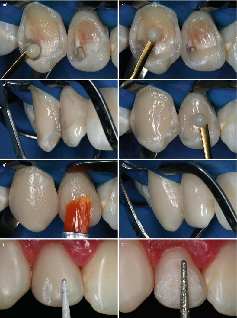 Composite Restoration On Anterior Teeth Springerlink Composite Restoration On Anterior Teeth Springerlink