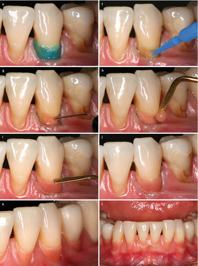 Composite Restoration On Anterior Teeth Springerlink Composite Restoration On Anterior Teeth Springerlink