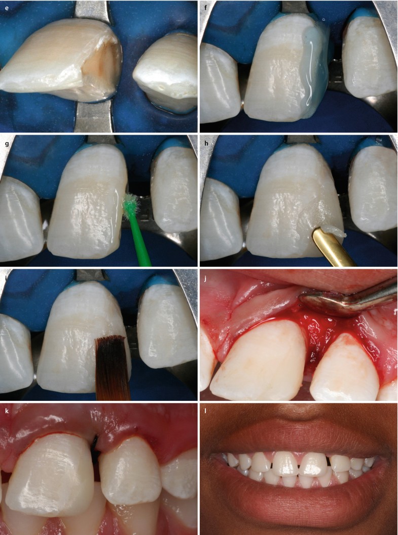 Composite Restoration On Anterior Teeth Springerlink Composite Restoration On Anterior Teeth Springerlink