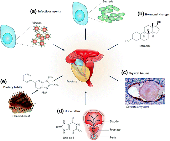 chronic fungal prostatitis