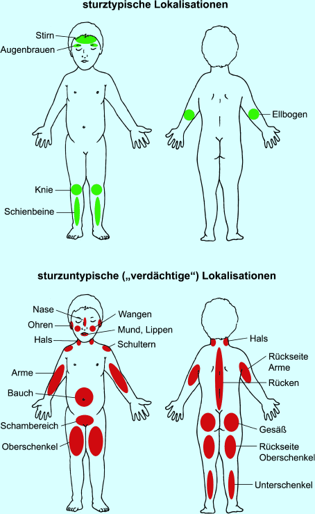 Abdrücken halsschlagader Abdrücken der