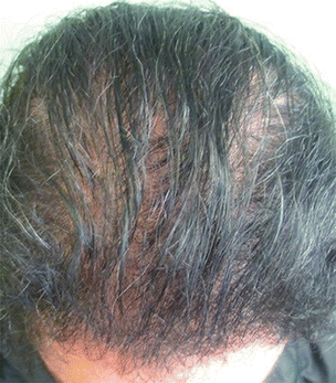 Alopecias Springerlink