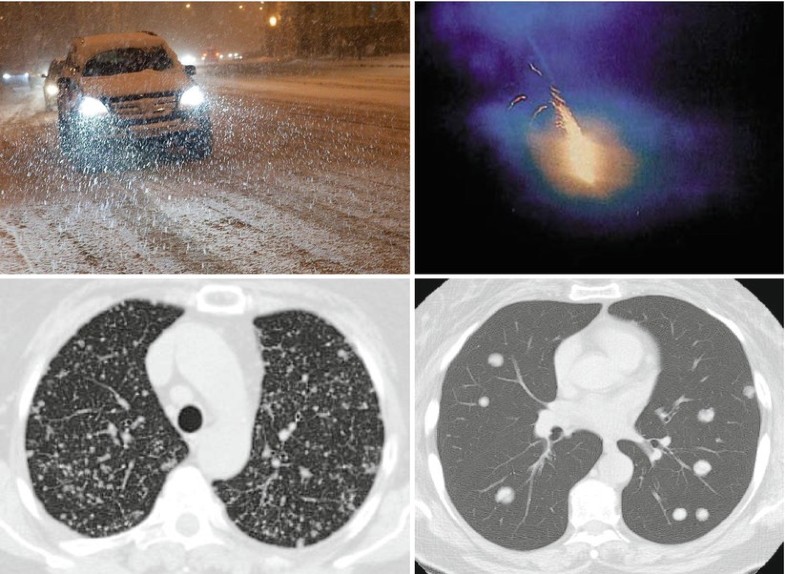 Snowstorm Sign and Cannonball Metastases SpringerLink