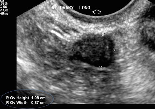 Ultrasound Imaging Of Gynaecologic Organs Springerlink