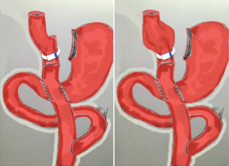 Laparoscopic Banded Gastric Bypass Surgery SpringerLink