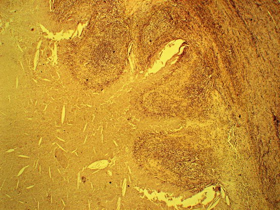 Prostatitis Bereza Mit csinál a prosztatitis gyulladása