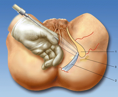 Pudendal Nerve Blockade Springerlink