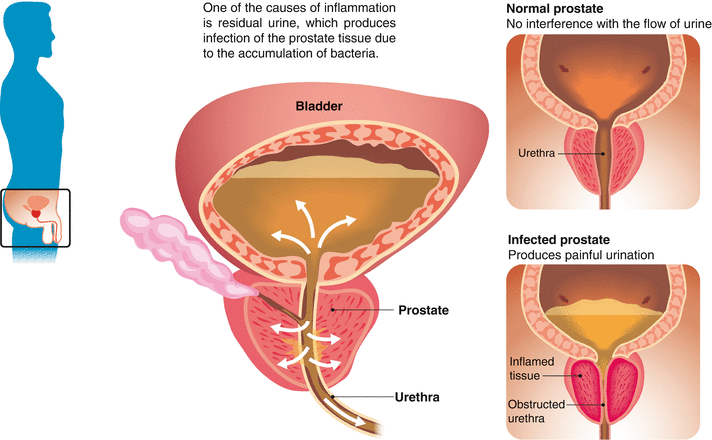Prostatit Urertrit W