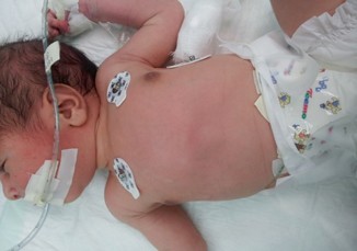 Congenital Diaphragmatic Hernia | SpringerLink Congenital Diaphragmatic Hernia | SpringerLink