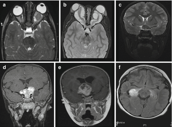 Optic Pathway Gliomas | SpringerLink
