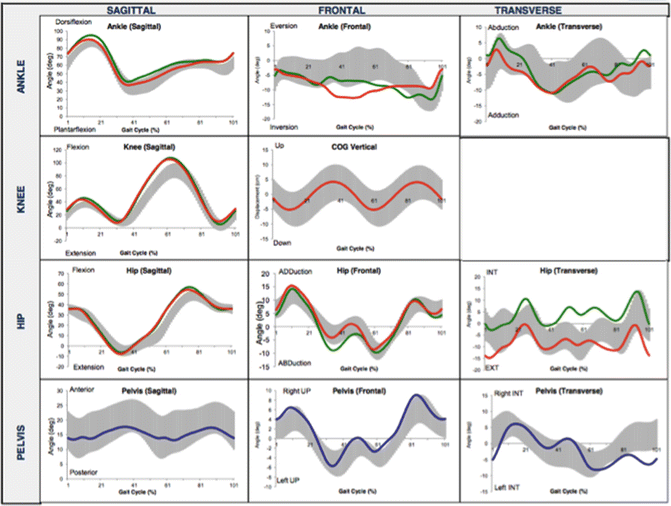 Biomechanics And Gait Analysis For Stress Fractures - 