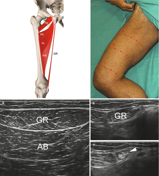 Adductors, Gracilis, and Pectineus SpringerLink