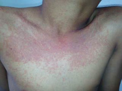 giardia skin manifestations)