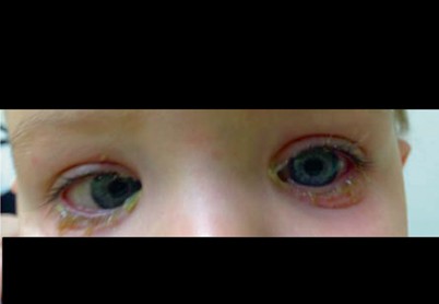 bilateral ectopic pupil icd 10 bilateral ectopic pupil icd 10