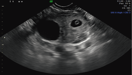 Ovarian Ectopic Pregnancy