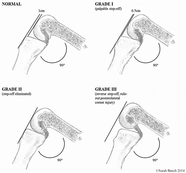 Clinical And Arthroscopic Evaluation Of The Posterior Cruciate