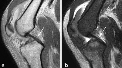 Mri Of Pcl Posteromedial And Posterolateral Corner Injuries Of The Knee Springerlink
