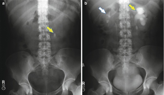 Stone Disease Imaging There Is More To X Rays Than What We See Springerlink