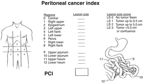 peritonealis rákindex pci)