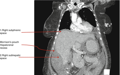 peritonealis rákindex pci)