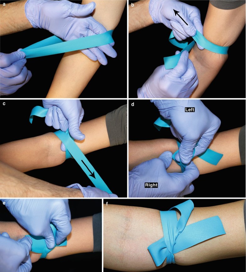 Venipuncture SpringerLink