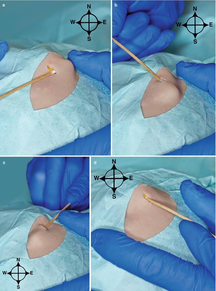 Incision and Drainage (Abscesses, Acne, and Milia) SpringerLink