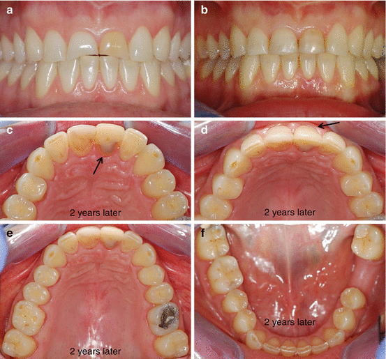 Cancerul bucal (oral). Ce este, care sunt simptomele si CUM se trateaza