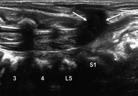 Neonatal Spine Abnormalities | SpringerLink