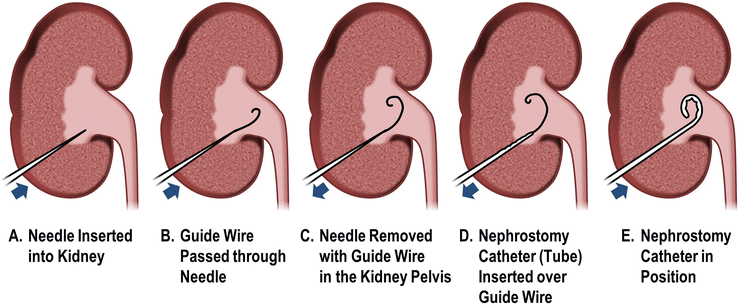 Https Www Baus Org Uk Userfiles Pages Files Patients Leaflets Percutaneous 20nephrostomy Pdf