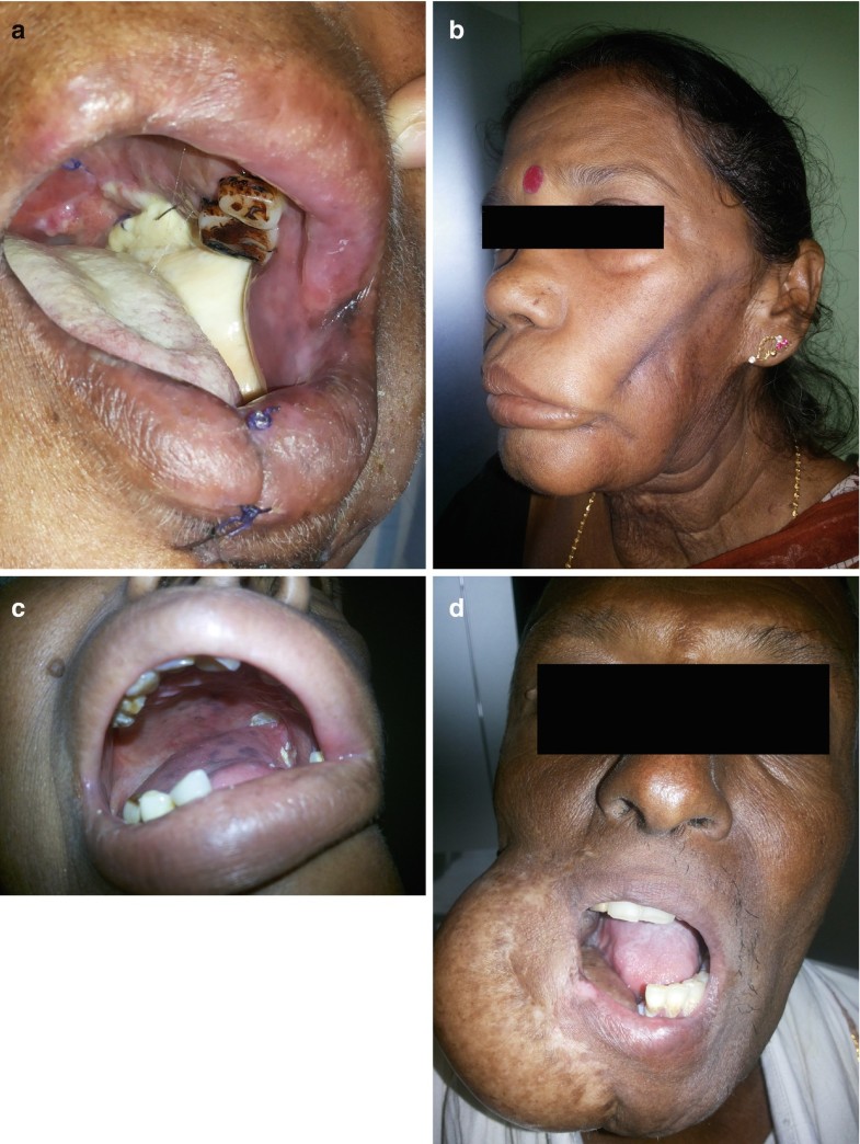 Photos Rare Mouth Filling Cysts Cause Extreme Issues For Infant