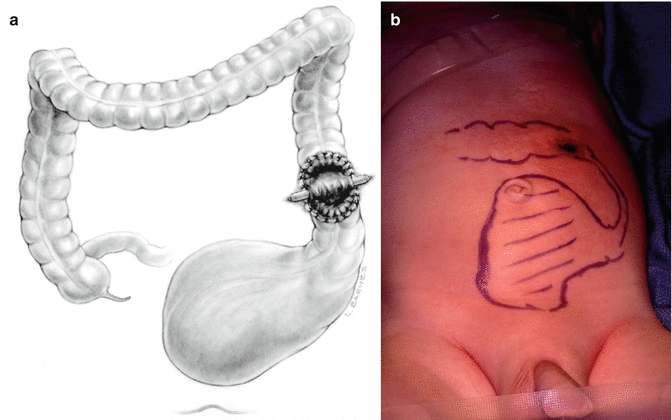 Colostomy | SpringerLink