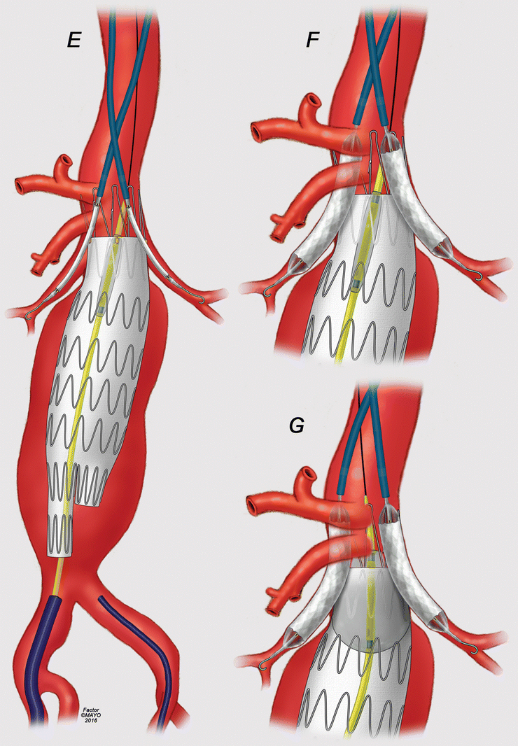 Parallel Graft Techniques to Treat Complex Aortic Aneurysms Involving