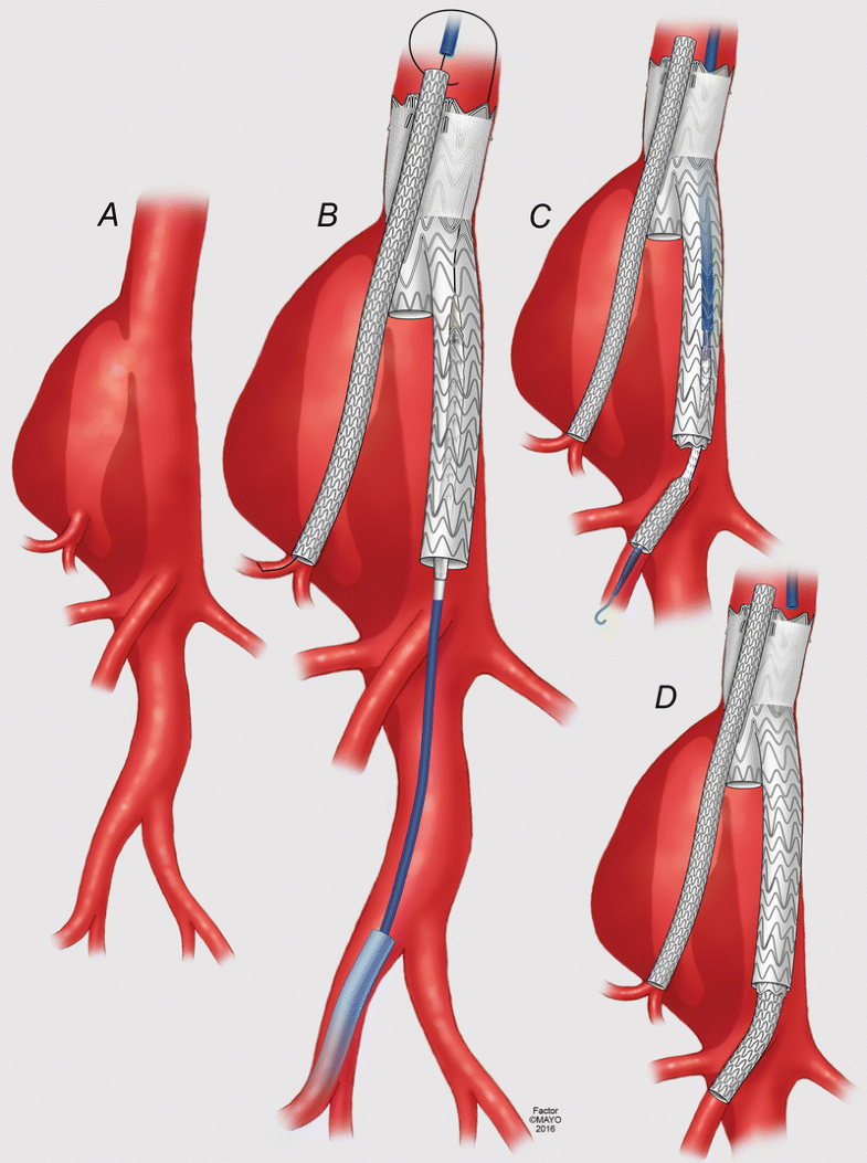 Растяжение аорты. Аневризма брюшной аорты разорванная. Веретенообразная аневризма аорты. Мешотчатые аневризмы аорты. Аневризматическое расширение нисходящего отдела грудной аорты.